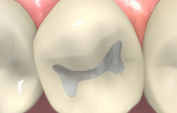 歯を削って修復する充填治療（進行状態：C1）