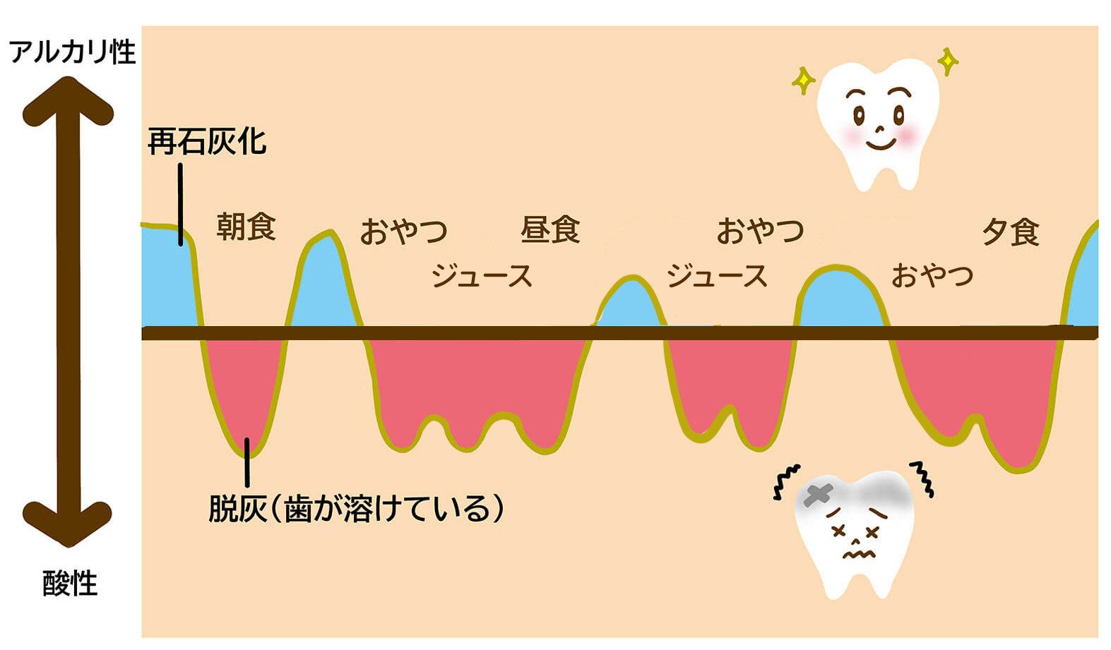 脱灰再石灰化, 脱灰 再石灰化 イラスト 無料 – AQAVPE