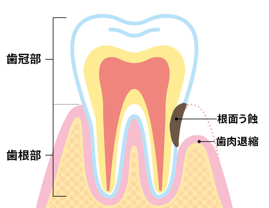 根面う蝕