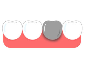 歯科用金属が抱える問題点