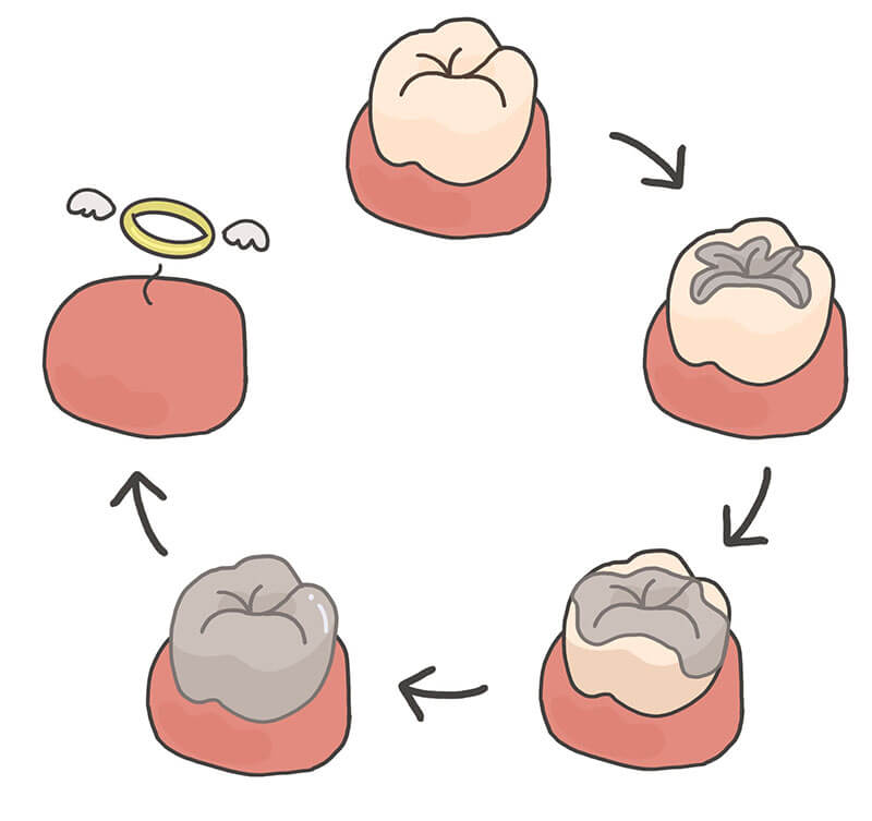 何度も治療を繰り返すと、最終的に歯を失ってしまうことも
