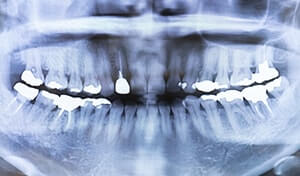歯のパノラマレントゲン